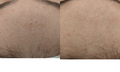 Авторский пилинг Антикомедональный